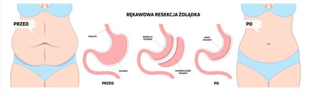 Operacja zmniejszenia żołądka na NFZ - gdzie i jak się kwalifikować Operacja zmniejszenia żołądka na NFZ - gdzie i jak się kwalifikować